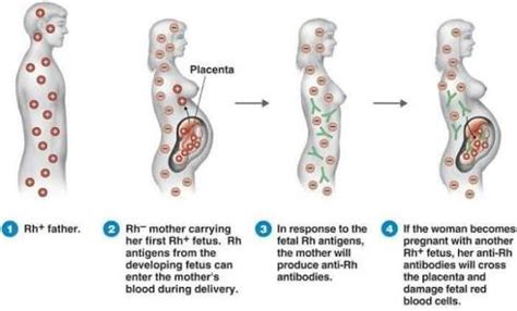 rhd positiv gravid|What is my rhesus status, and how will it affect my。